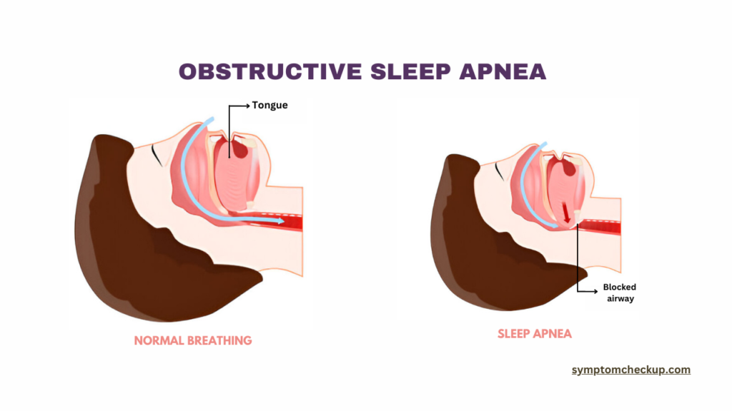 snoring sleep apnea