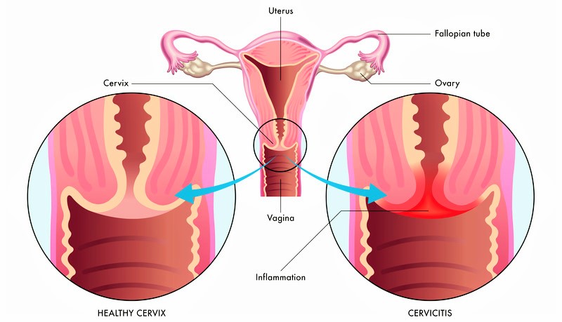 Healthy cervix vs Cervicitis 