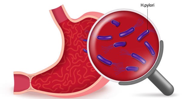 Helicobacter pylori Infection